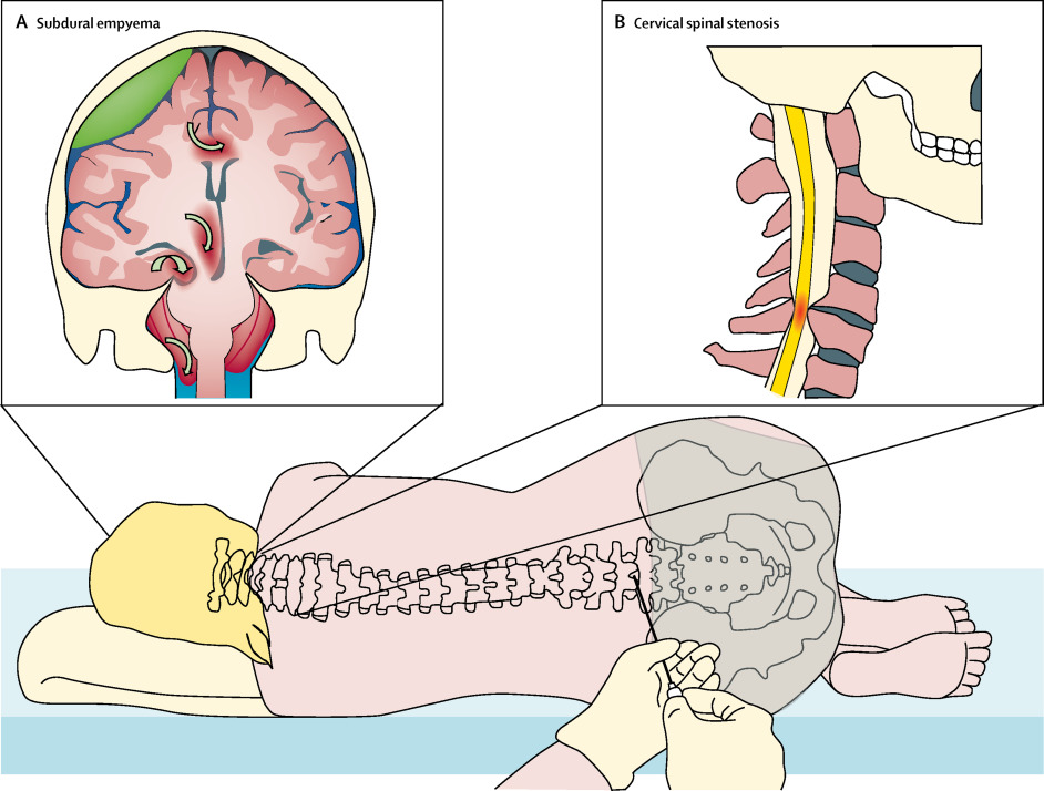 Technological advances and changing indications for lumbar puncture in neurological disorders.