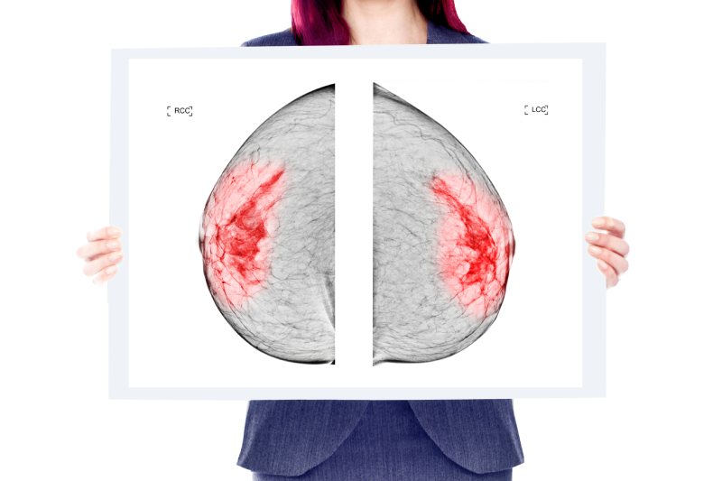 A woman holding an x ray on a white background creating breast cancer awareness among women.