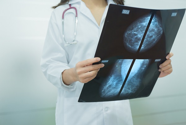 Image of a female doctor holding a mammogram film and analysing the result.