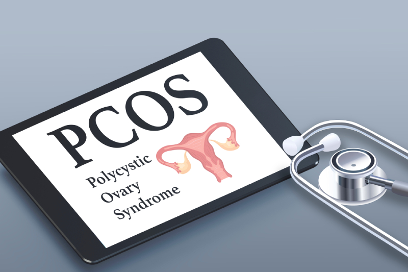The term Polycystic ovary syndrome and image of uterus displayed on a tablet with a stethoscope next to it kept on a grey background.