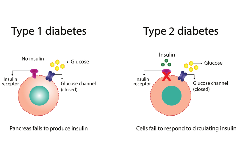 Diagram illustration showing the difference between Type 1 and type 2 diabetes.