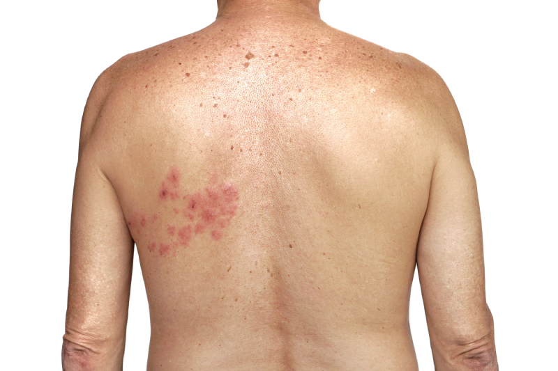 Close up view of a man's torso/upper back with red coloured blisters indicating Herpes zoster appearing below the left shoulder.