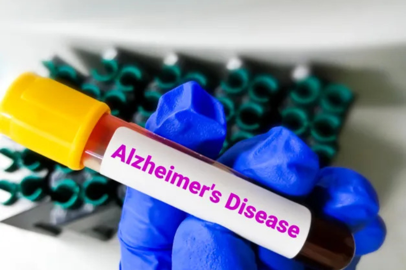 A closeup image of a hand wearing blue gloves holding a blood sample tube with the words Alzheimer disease written on it, and blurred image of test tube holders shown at the background.